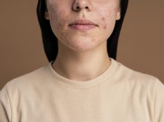 Mengenal Acne Patch dan Kegunaannya Pada Kulit Berjerawat